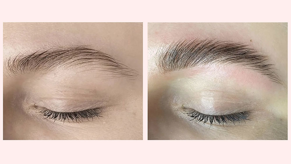 ForBrow before and after