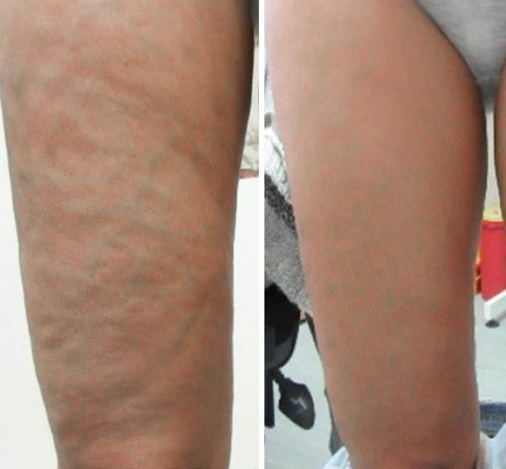 B-Foxy Inner Thigh Firming Cream before and after
