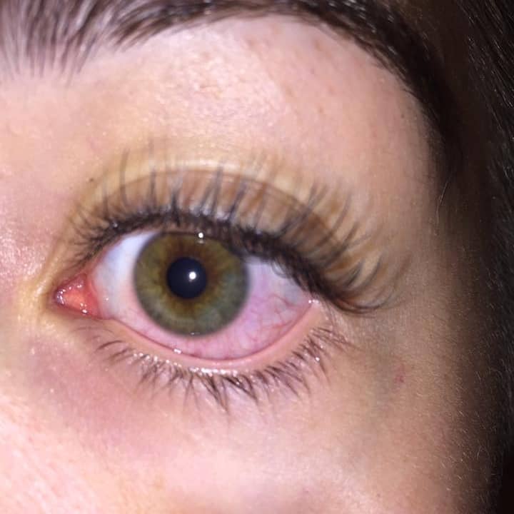 Red Eyes After Eyelash Extensions