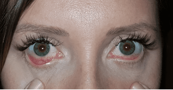 bloodshot after eyelash extension