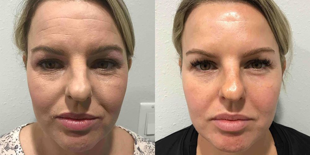 botox customer reiews