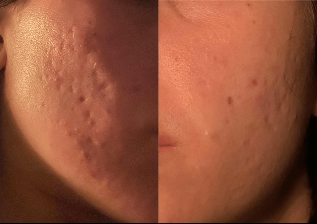 microneedling side effects