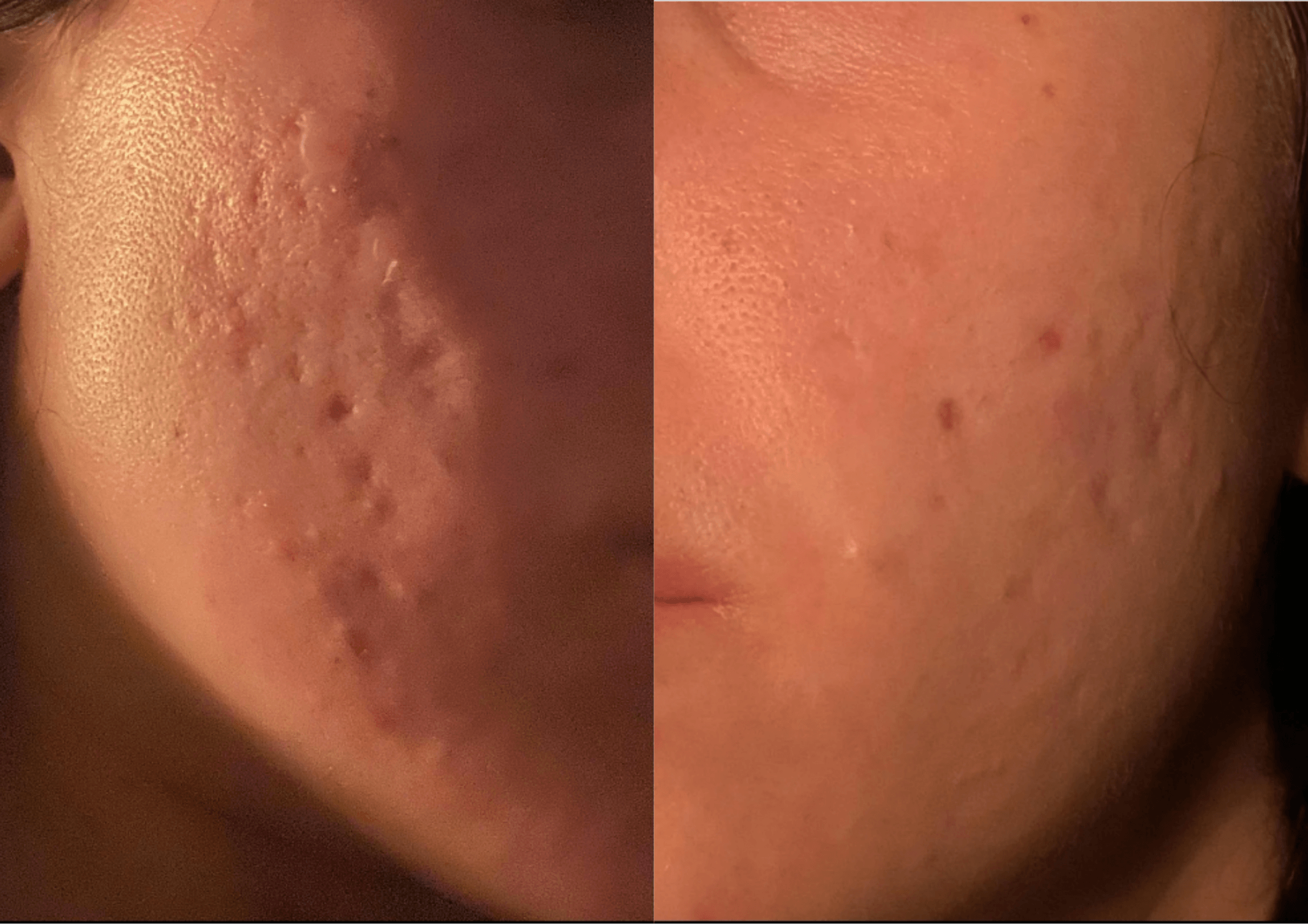 skin-looks-worse-after-microneedling-3-case-studies-to-learn-from