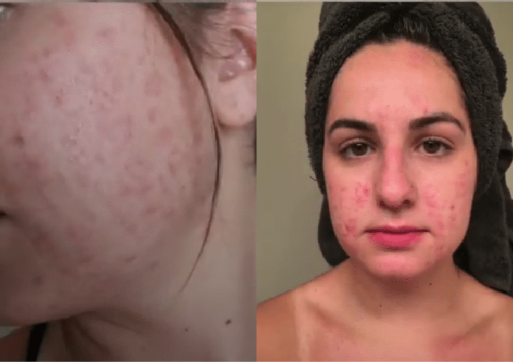 microneedling gone wrong