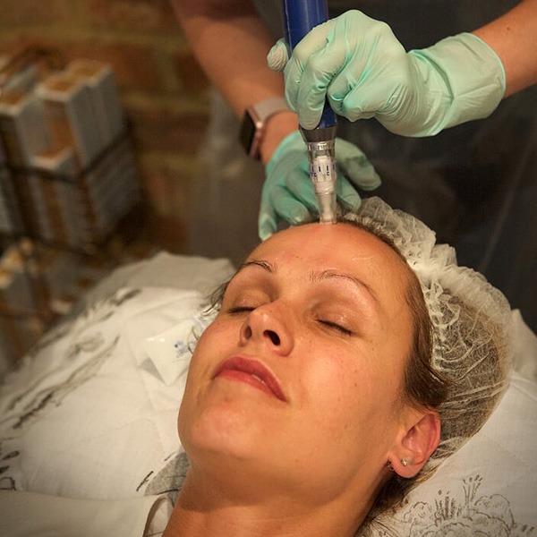 microneedling 