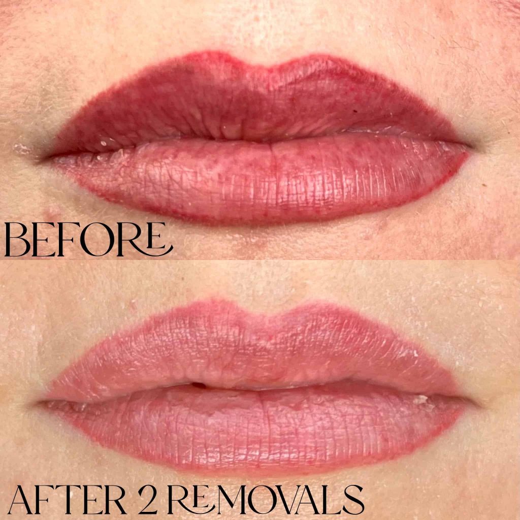 Lip Blushing laser removal