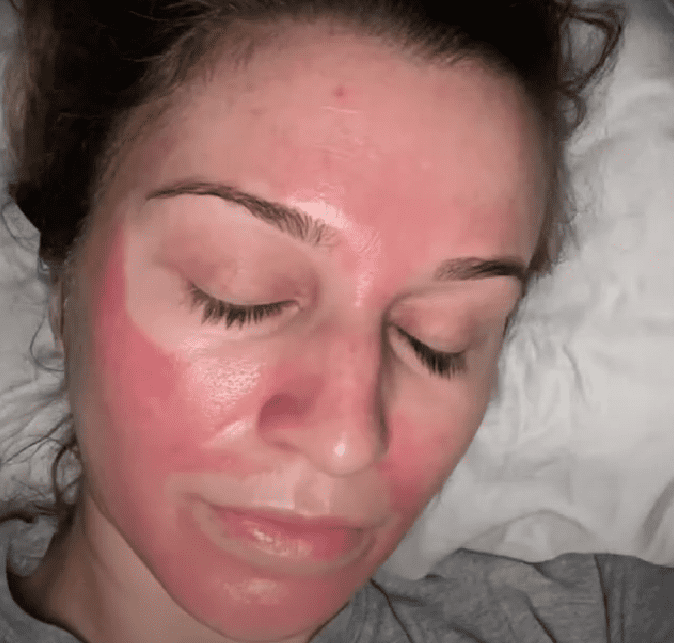 chemical peel disaster