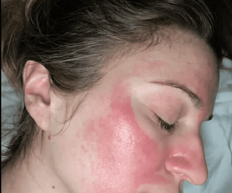 chemical peel side effects