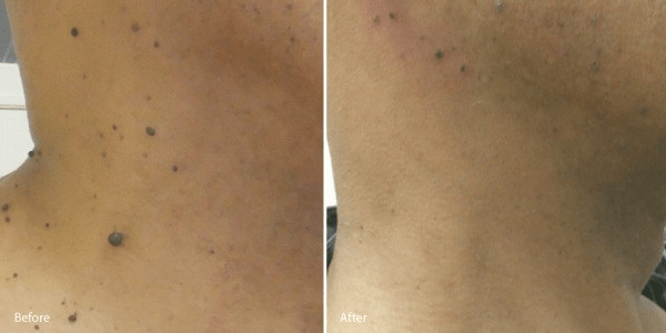 skin tag removal 