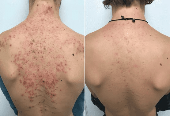 Herbaluxy Back Acne Reviews 