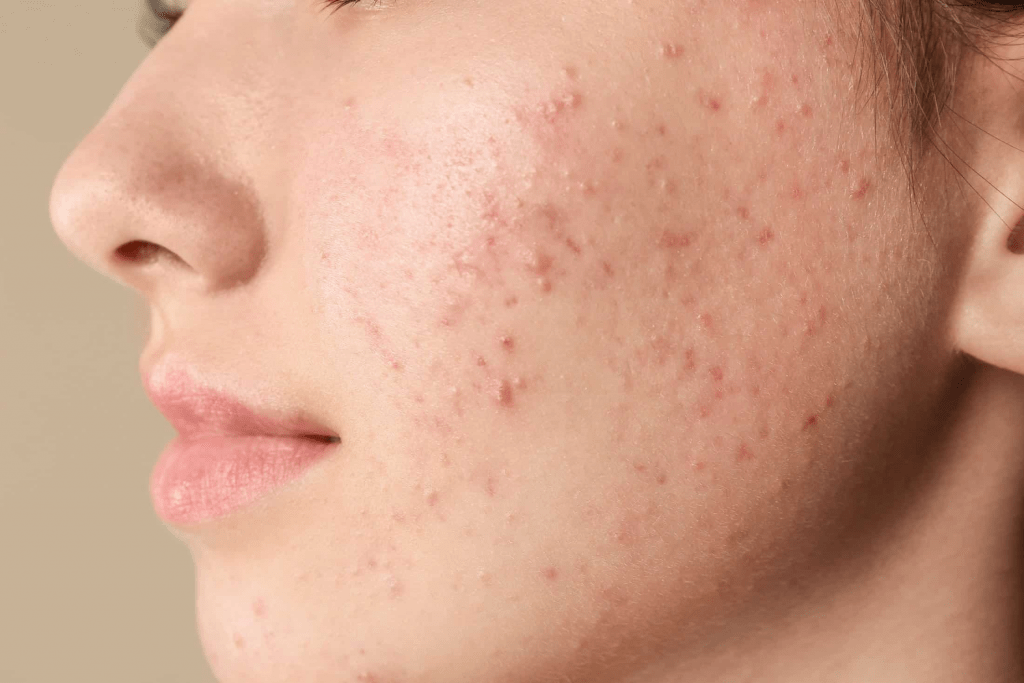 acne 