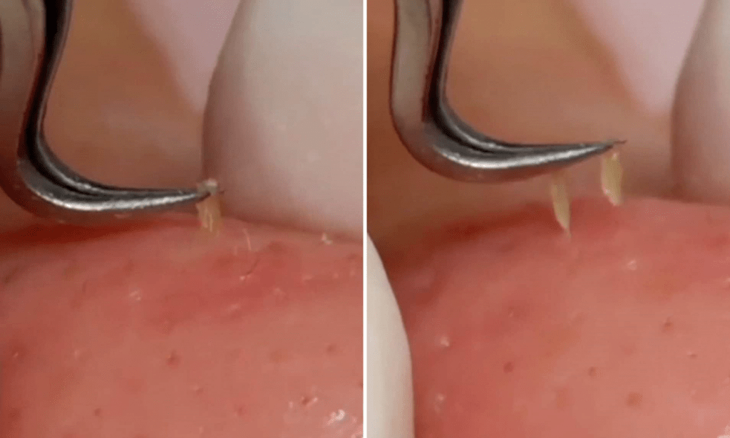 Pulling Out Sebum Plugs With Tweezers