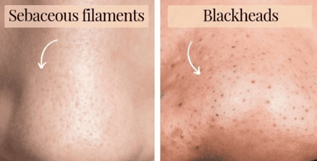 sebaceous filaments vs blackheads 