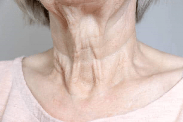 neck aging 