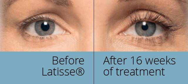 latisse clinical trials 