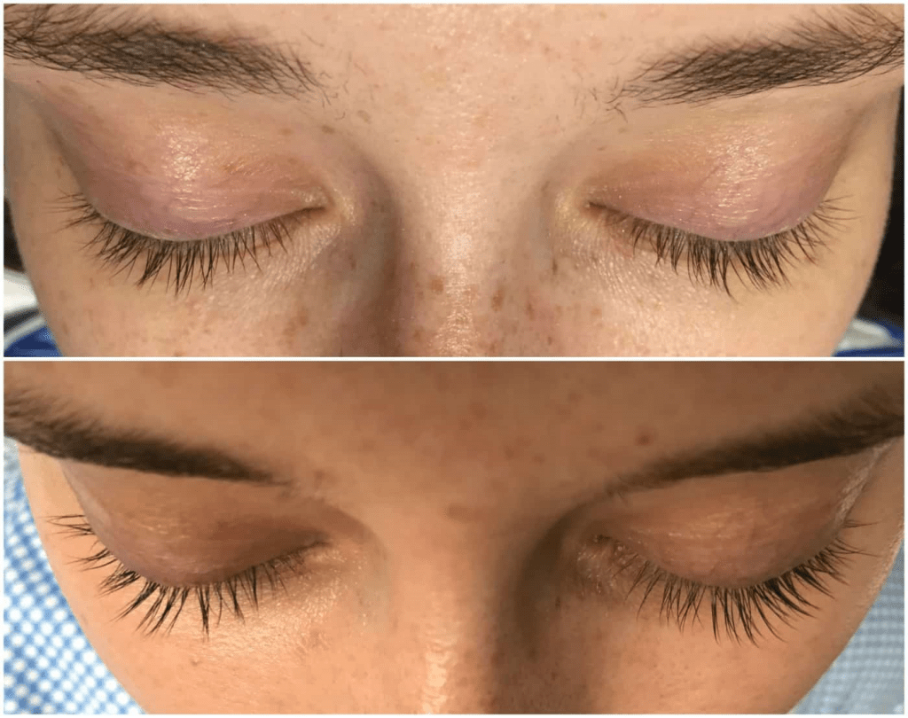 neulash before and after 