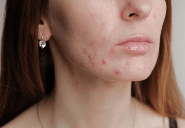 acne breakouts 