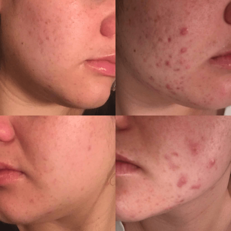 Spearmint Tea For Acne Does It Really Help? Blushastic