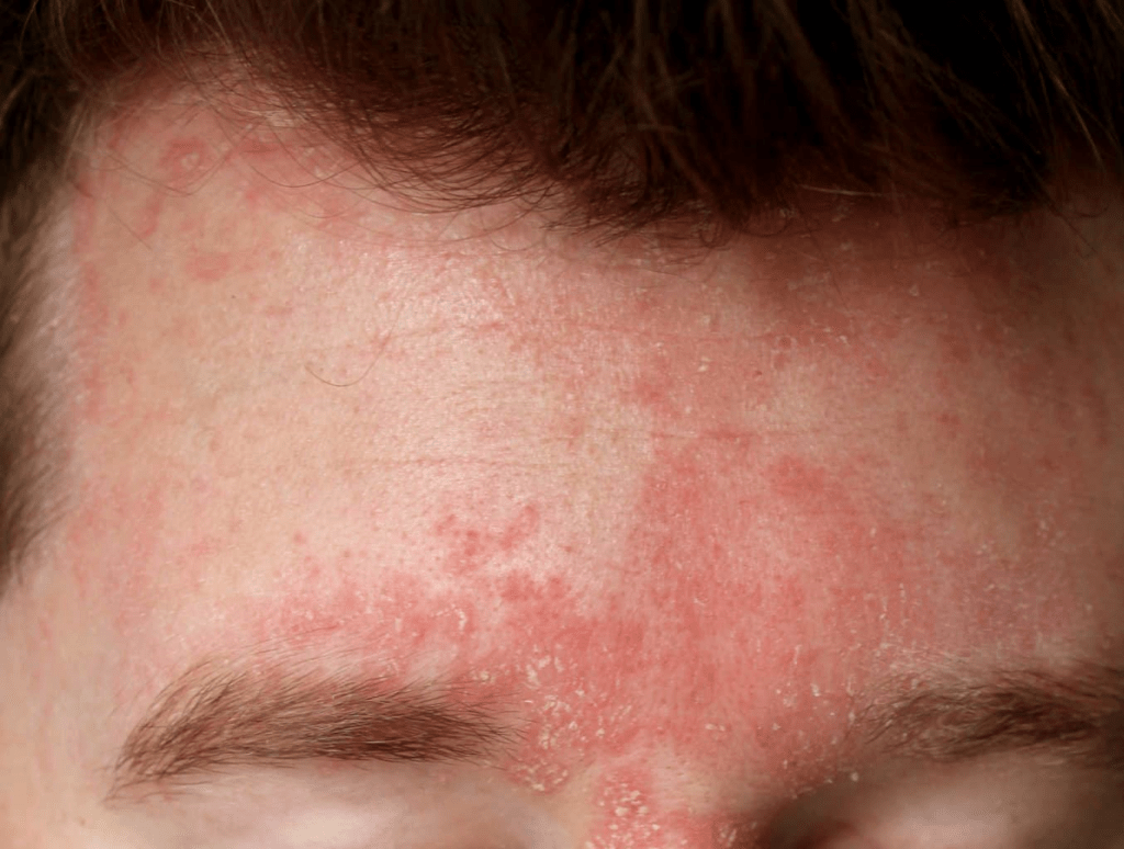 contact dermatitis 