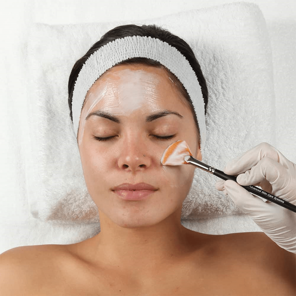 chemical peels 