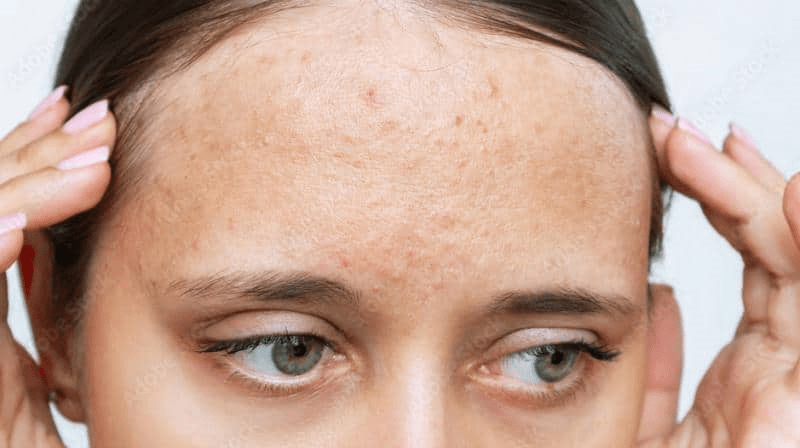 bumps on forehead 