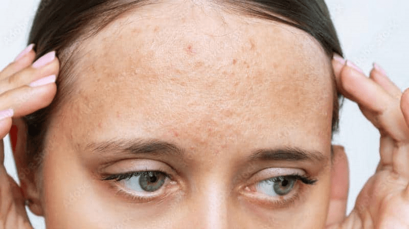 Bumps On Forehead Causes And Solutions Blushastic