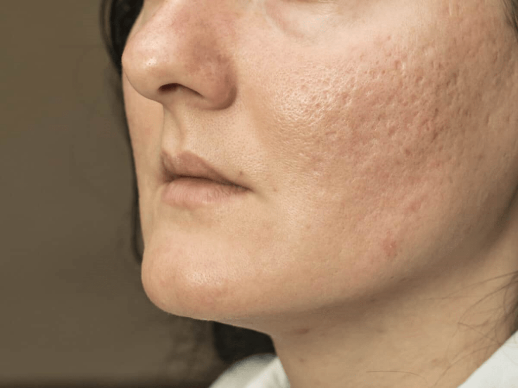 acne scars 