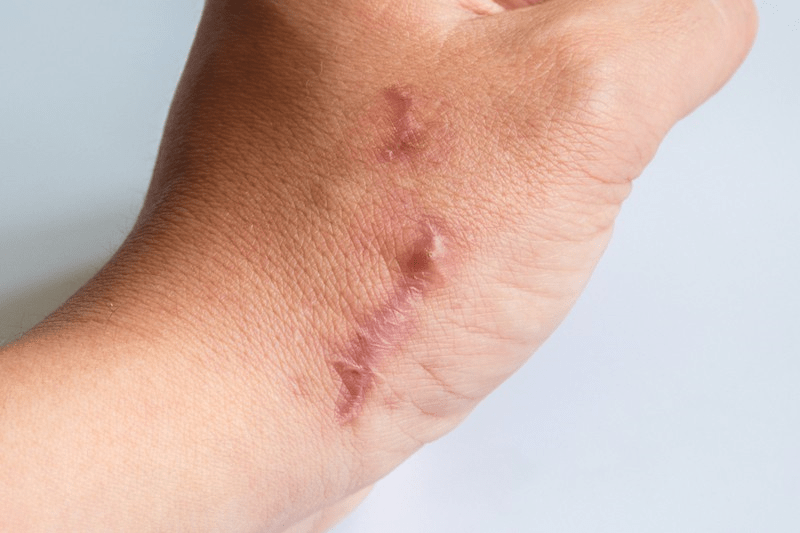 keloid scars 