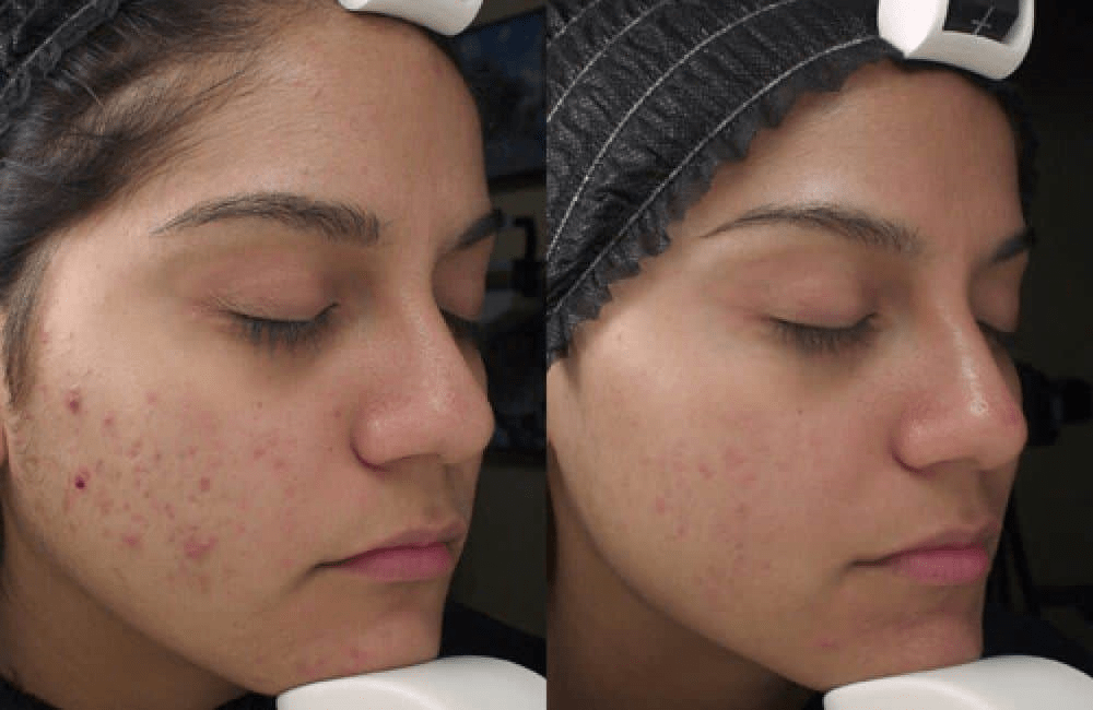 acne scars before and after 