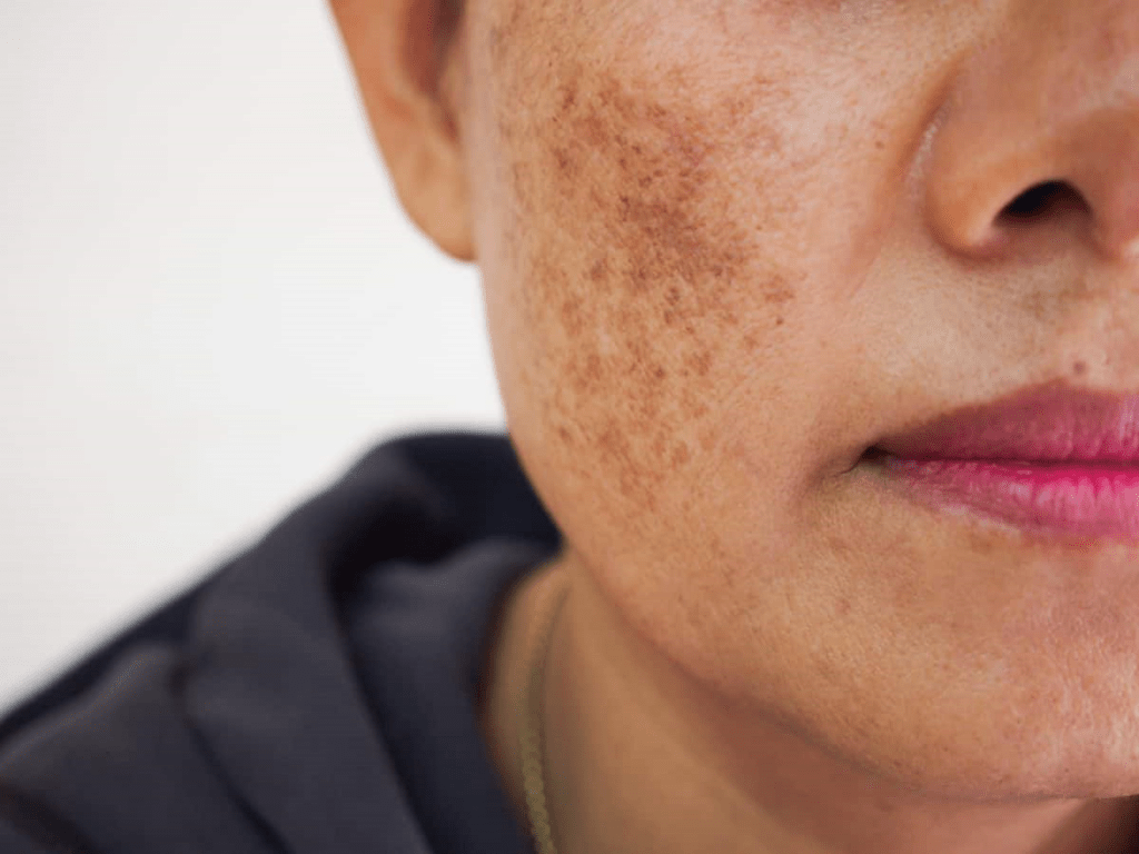 melasma 