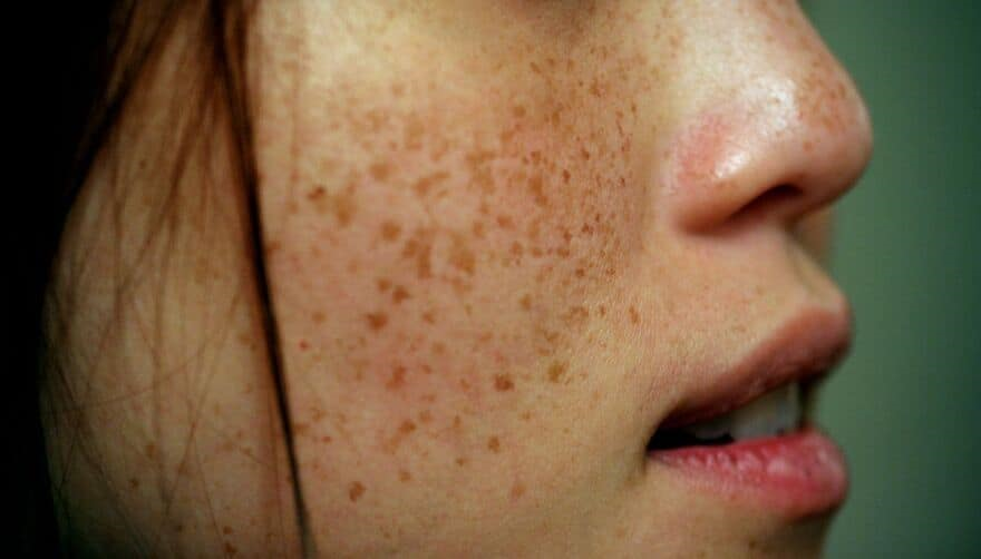 freckles 