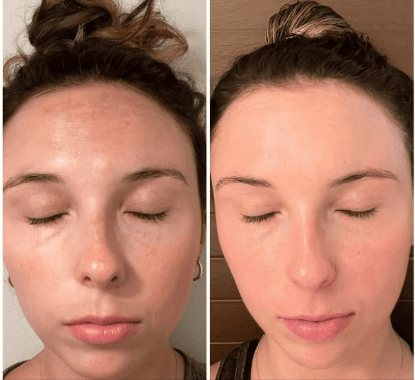 Musely Spot Cream before and after 