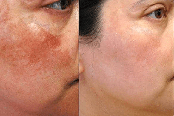 hyperpigmentation before and after 