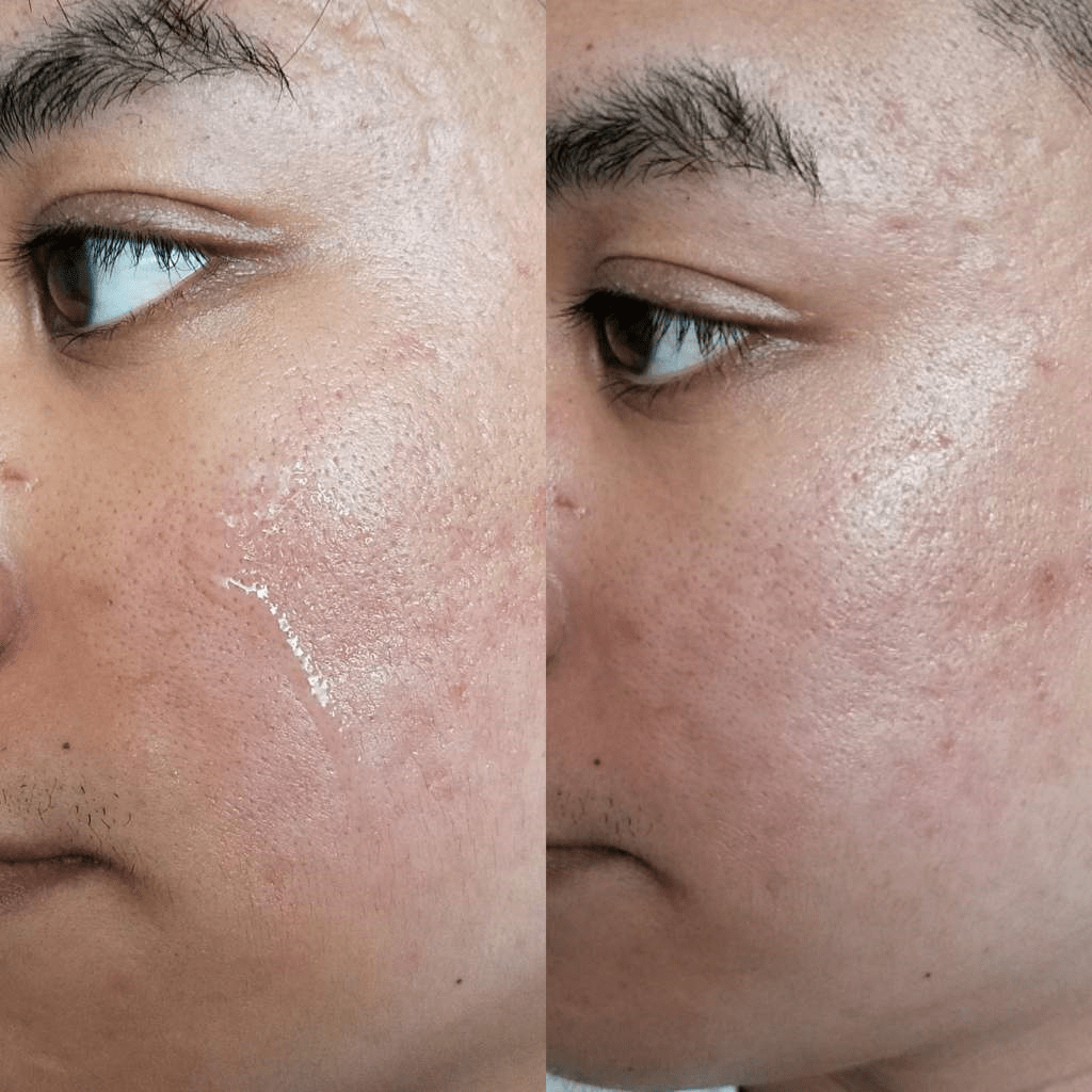 cosrx snail mucin essence before and after 