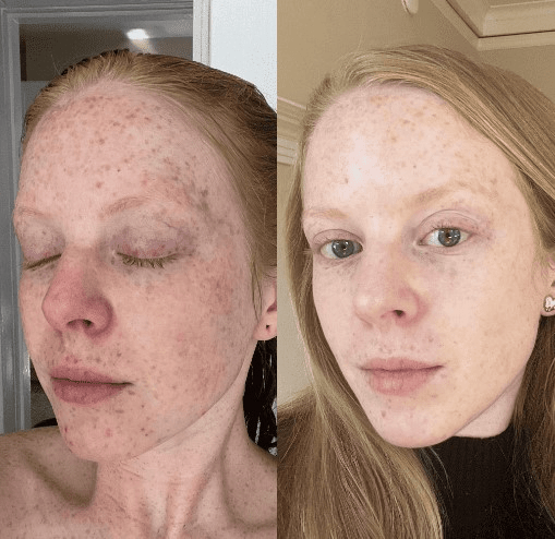 vitamin c before and after 