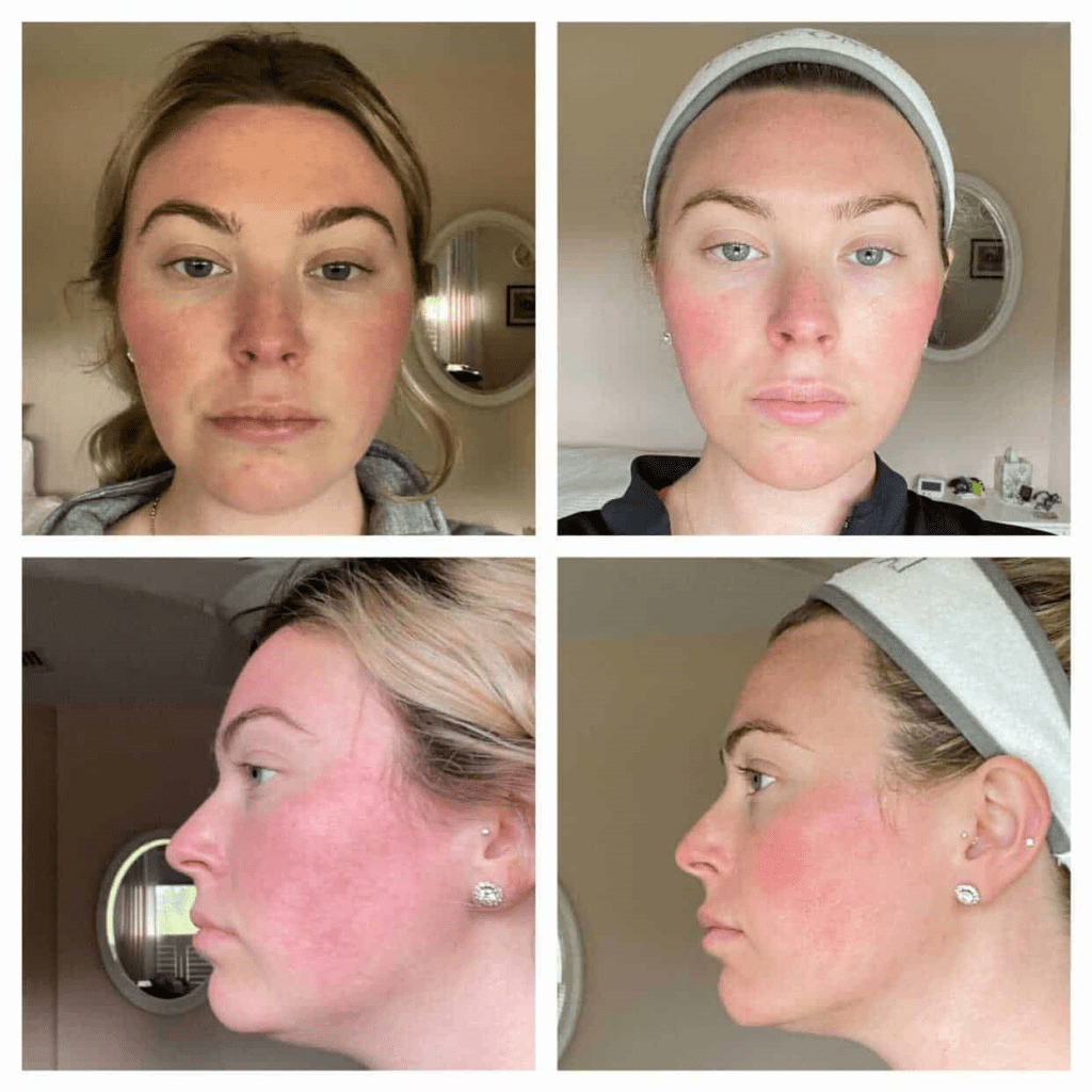nuface before and after 
