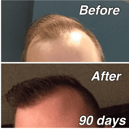 Nioxin Hair Regrowth Treatment Reviews before and after 