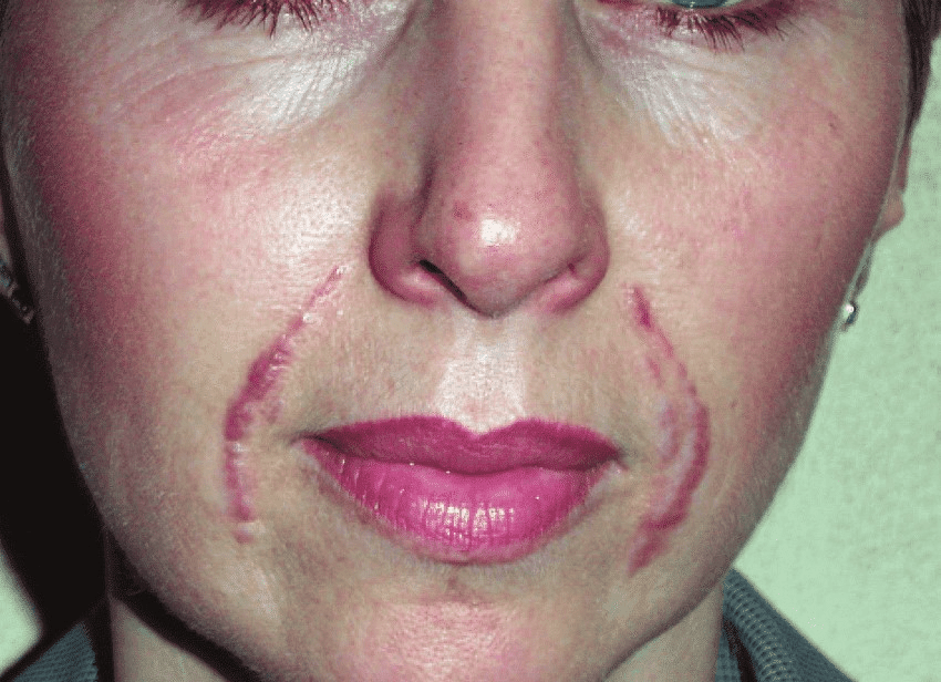 Nasolabial Fold Filler Gone Wrong