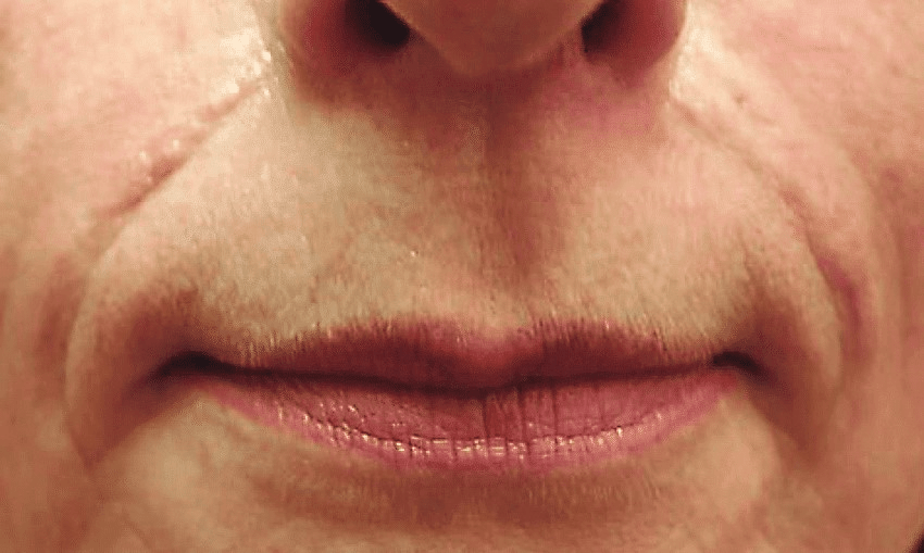 nasolabial fold filler gone wrong