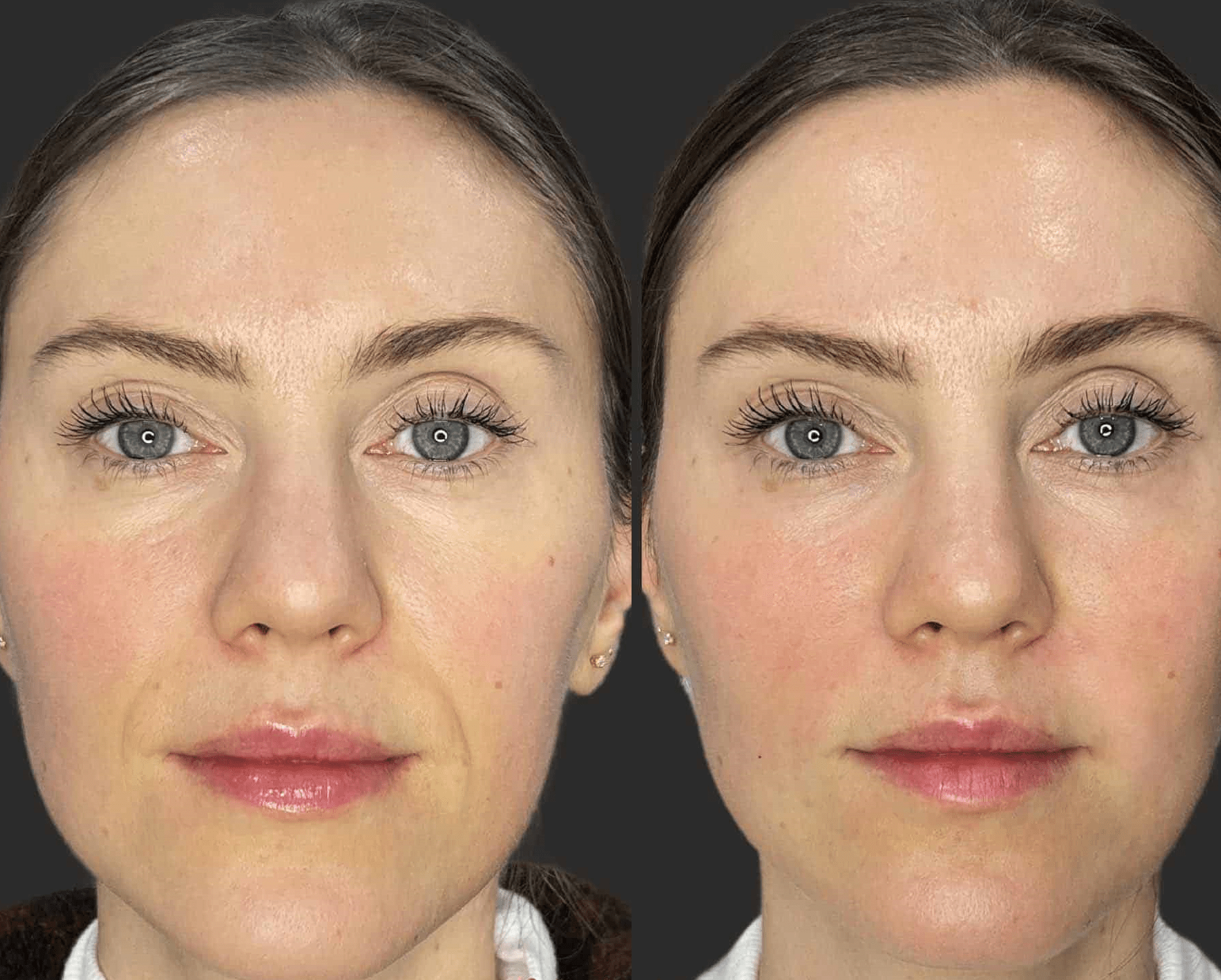 nasolabial fold filler before and after 