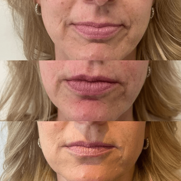 Too Much Filler in Nasolabial Folds?